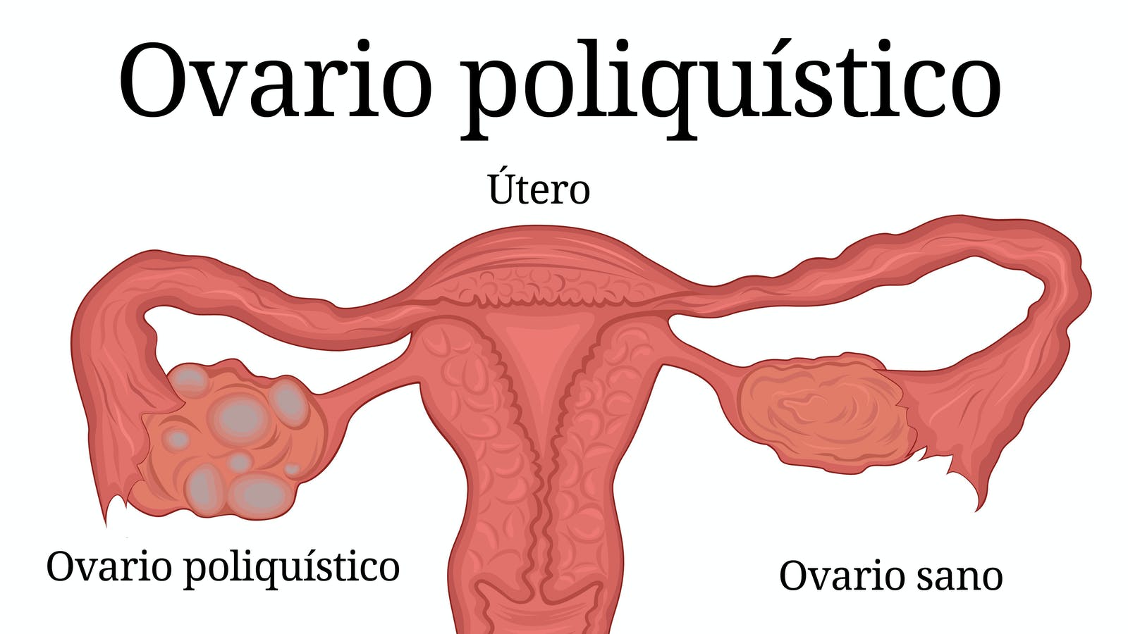 Todo lo que tienes que saber del síndrome de ovario poliquístico Nutriologa En Metepec